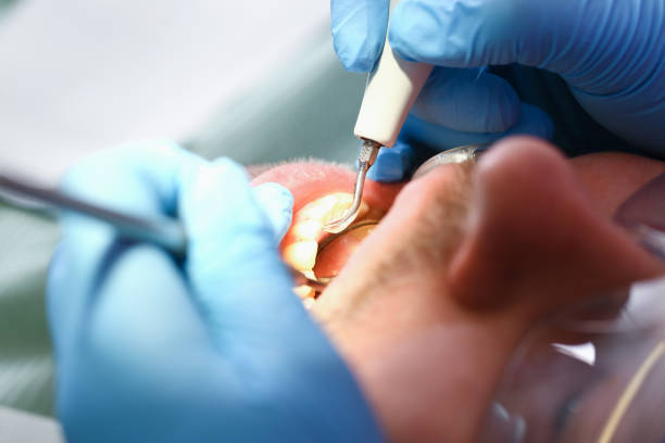 Best Chipped Tooth Repair Near Me  in Kennedy, CA